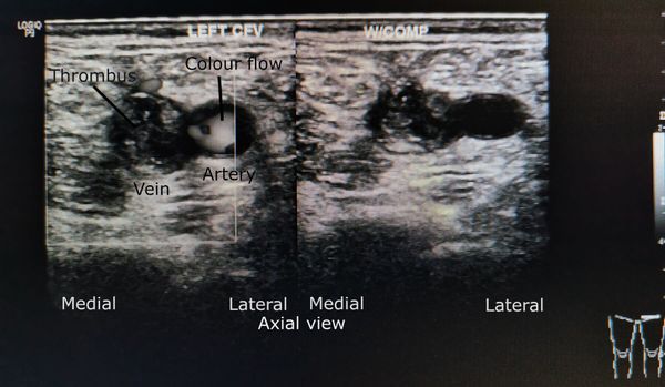 Imagen ecográfica transversal de la vena femoral común izquierda antes y durante la compresión; la vena no colapsa por trombo.