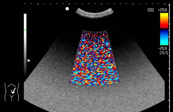 Ecografía Doppler color con mosaico rojo, azul y amarillo por ruido y artefacto flash durante una exploración abdominal