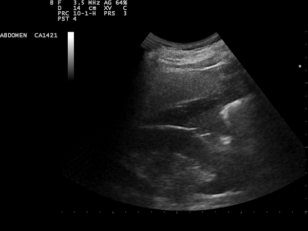 Ecografía del receso hepatorrenal con una banda anecoica de líquido libre entre el hígado y el riñón derecho.