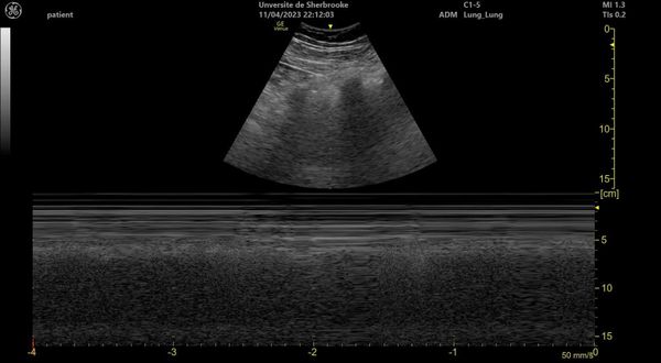 Ecografía pulmonar en modo M con signo de la orilla de mar: líneas horizontales superficiales y textura granular bajo la pleura.