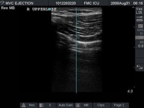 Ecografía pulmonar que muestra el lung point, transición respiratoria compatible con el límite lateral de un neumotórax.
