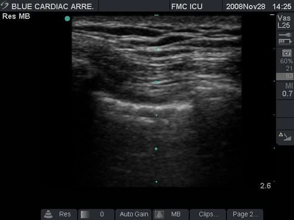 Ecografía pulmonar en modo B con la línea pleural entre las sombras costales durante sliding pleural normal.