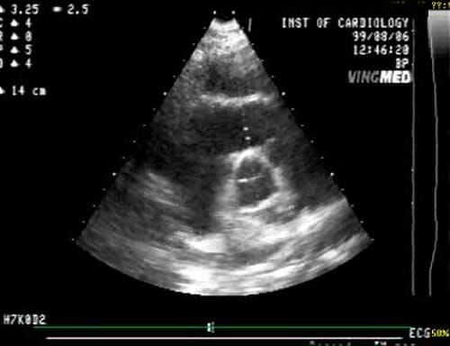 Ecocardiografía con colapso diastólico de cavidades derechas por taponamiento cardíaco