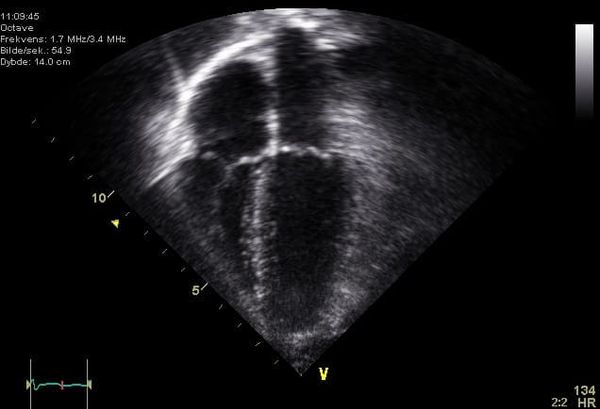 Vista ecocardiográfica apical de cuatro cámaras utilizada para delimitar el ventrículo izquierdo