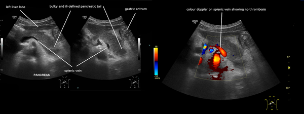 Ecografía con cola pancreática aumentada y de límites poco definidos, y Doppler color de la vena esplénica