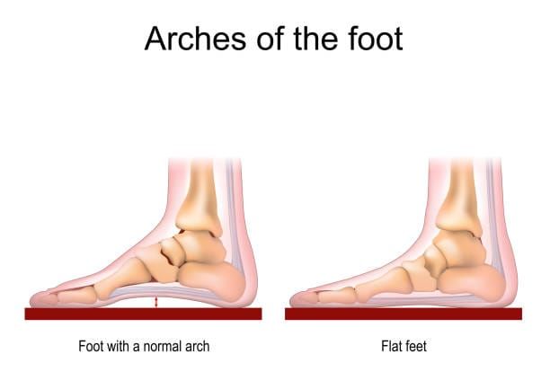 The Agony of De Feet.