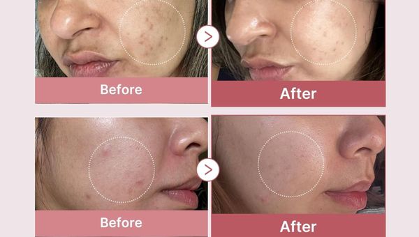 Unlock Radiant Skin: How PDRN Serum Revitalizes and Repairs Your Skin Naturally