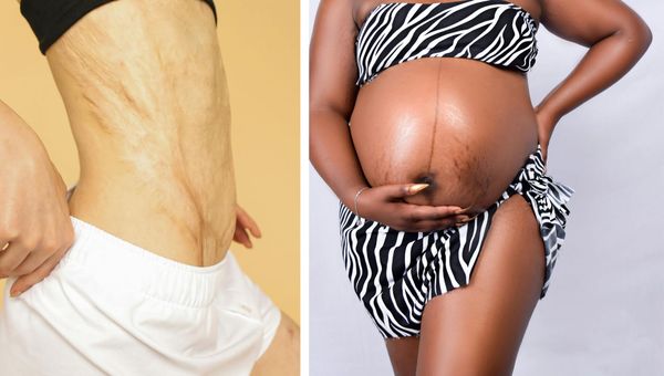 Reduce the appearance of surgical scars and stretch marks with silicone scar tape.