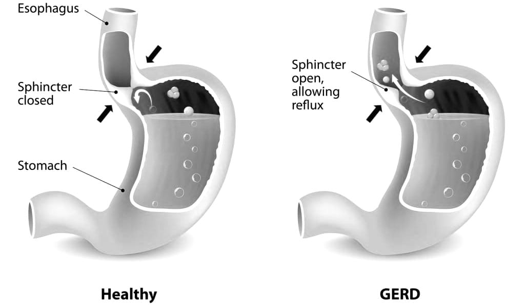 GERD (Gastroesophageal Reflux Disease)