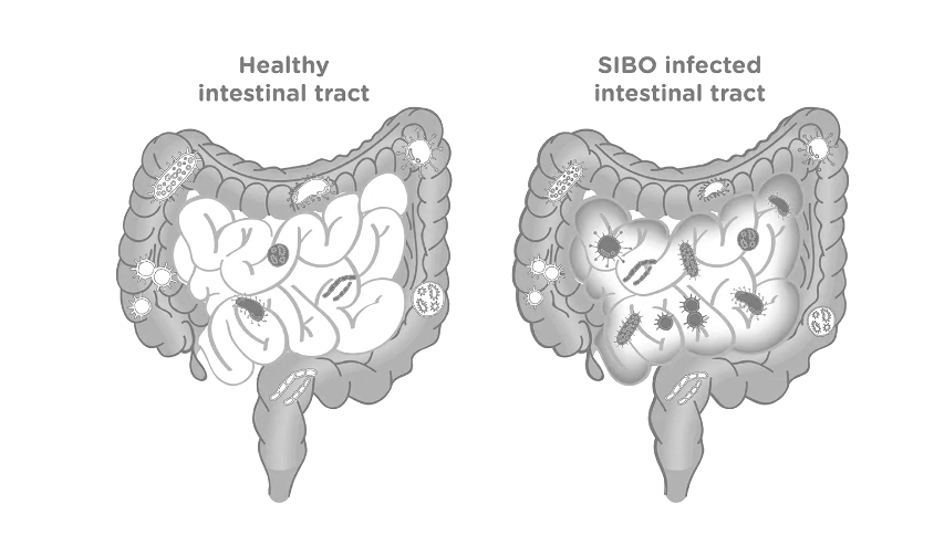 Small Intestinal Bacterial Overgrowth (SIBO)