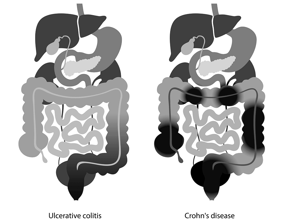 Inflammatory Bowel Conditions