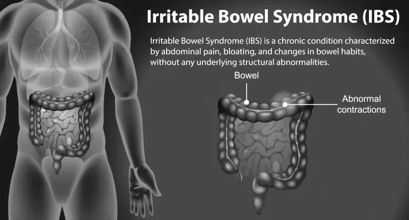 IBS (Irritable Bowel Syndrome)