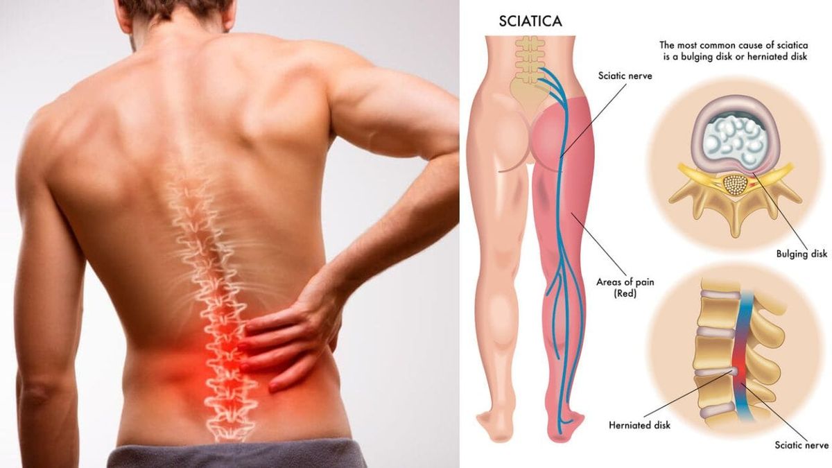 What Can Make Sciatica Worse? Top Factors & What to Avoid