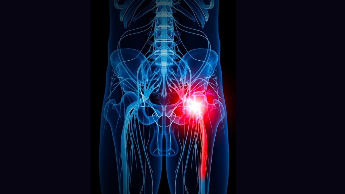 What Is Stage 4 Sciatica? Symptoms Causes & Treatments
