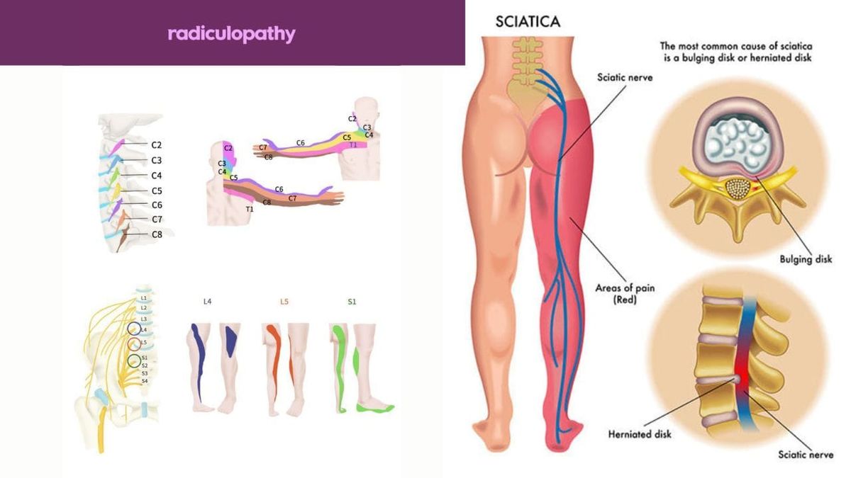 Sciatica vs. Radiculopathy:  Diagnosis Causes & Treatments