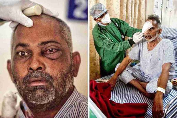 india-black-fungus-covid thumbnail