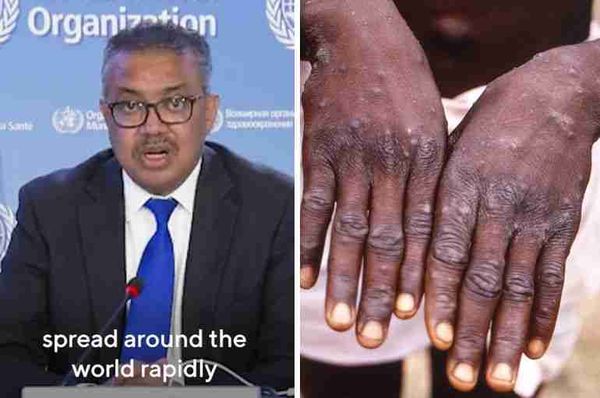 monkeypox global health emergency WHO