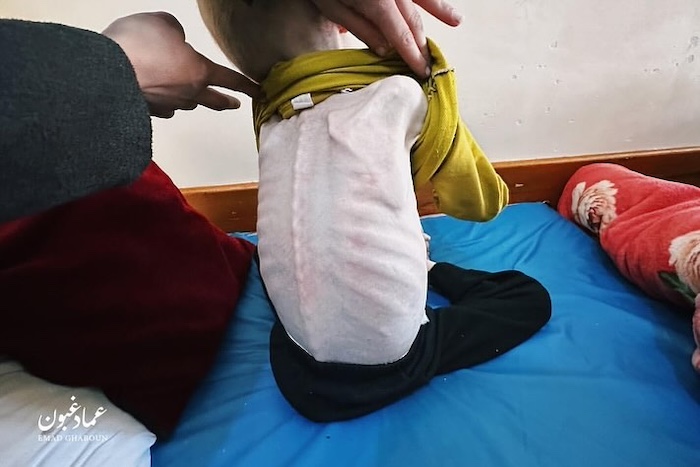 gaza children starved israel attack