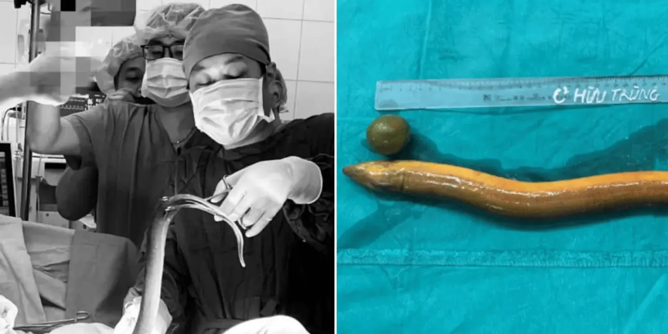Médicos extraen anguila viva del intestino de un hombre