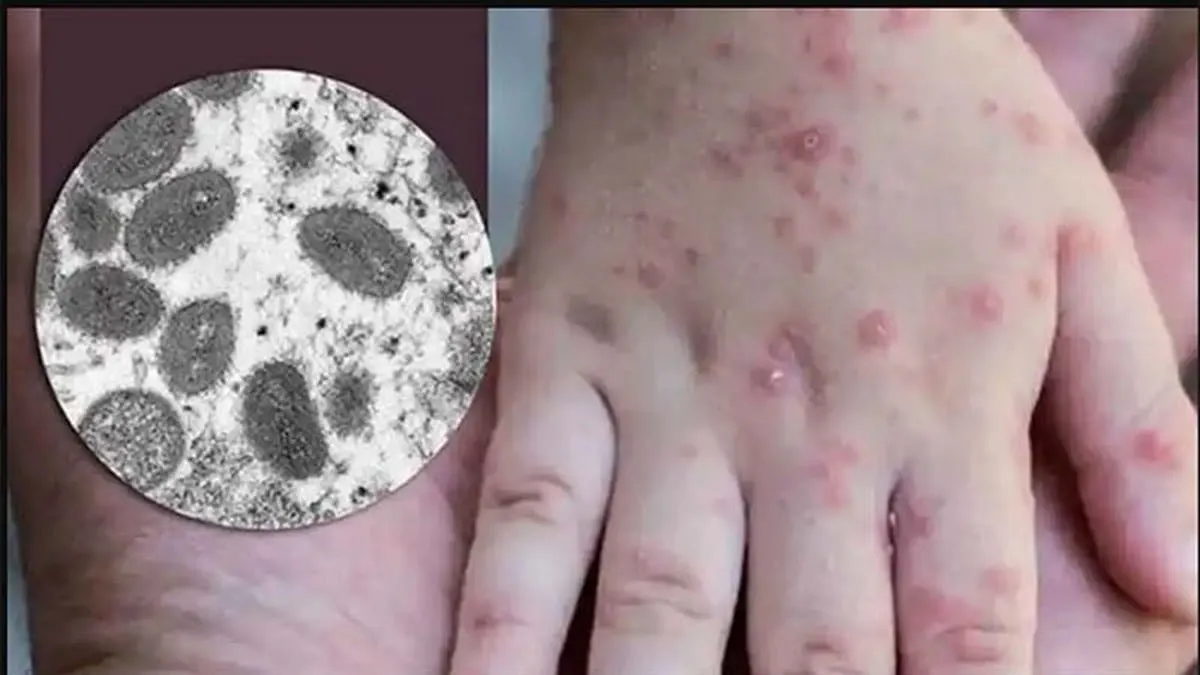 Viruela del Mono: ¿quiénes deben usar mascarilla ante nuevo brote de Mpox?
