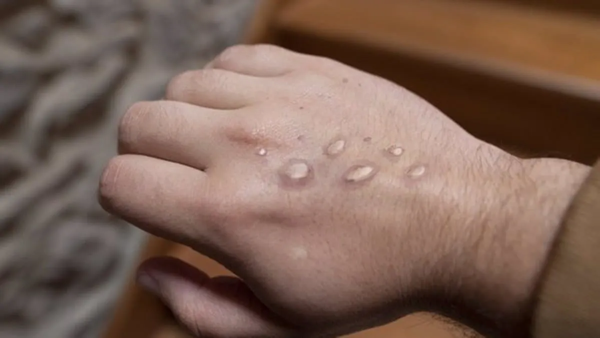 Viruela del Mono (Mpox) ¿Cómo se contagia? ¿Hay cura?