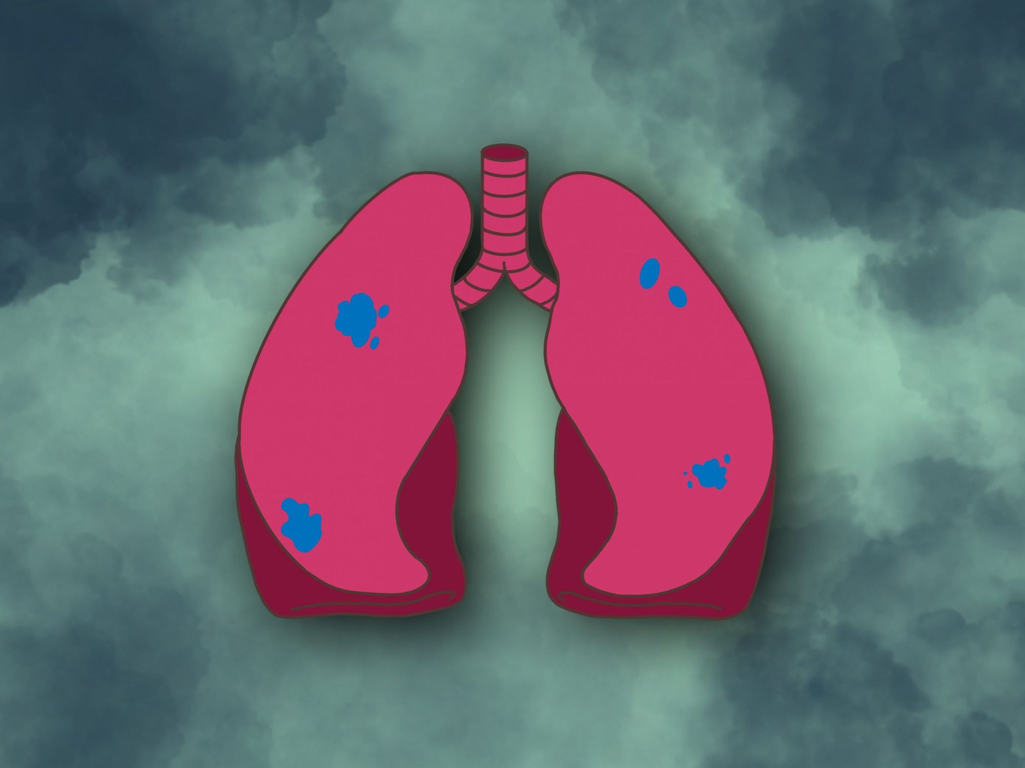 Unmasking the Reality of Lung Cancer looks to raise funds for U of C's cancer research initiatives
