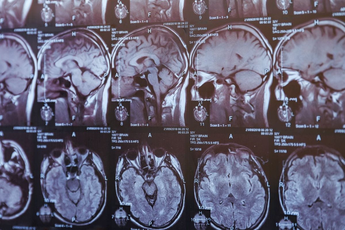 Concussions in Football - A Review of Current Evidence and Practice Gaps