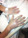 The right hand of Vicky Jo Baker is much larger than the left
due to swelling after she was bitten by a cat in the Hatcher Pass
area. (Photo courtesy Vicky Jo Baker)