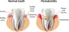periodontal disease by Elen Bushe