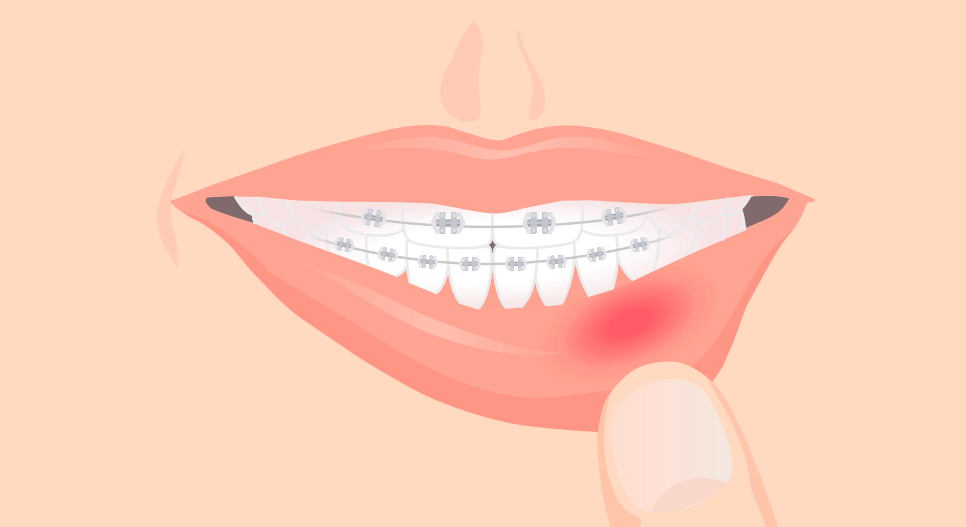성장기 교정을 위한 교정장치로 인해 입술이 튼 이미지