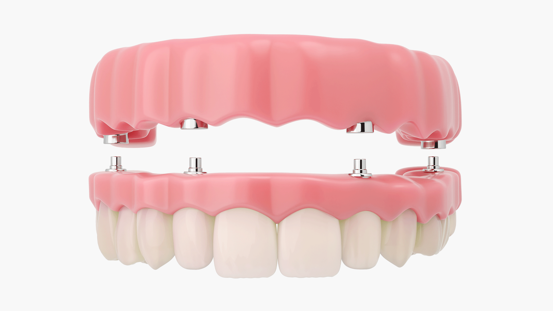 임플란트 틀니의 보철물 