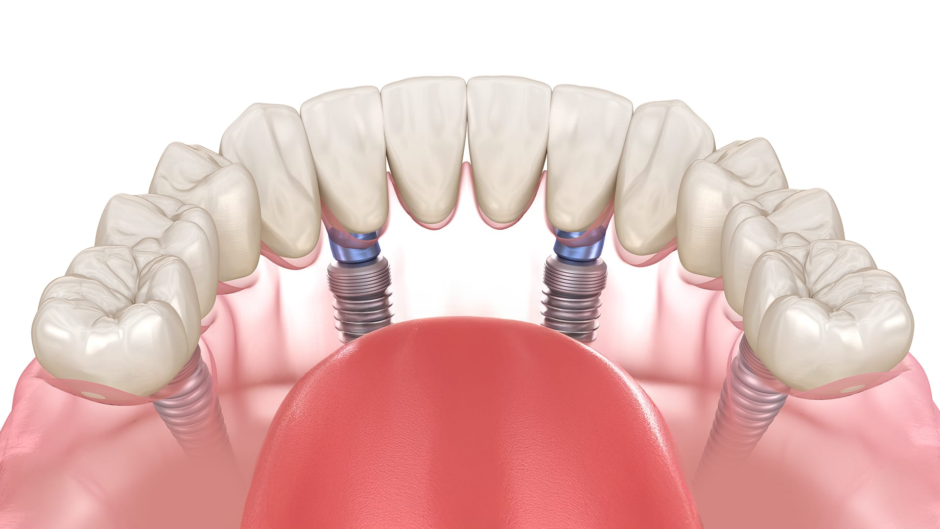 풀아치 임플란트가 식립된 모습 