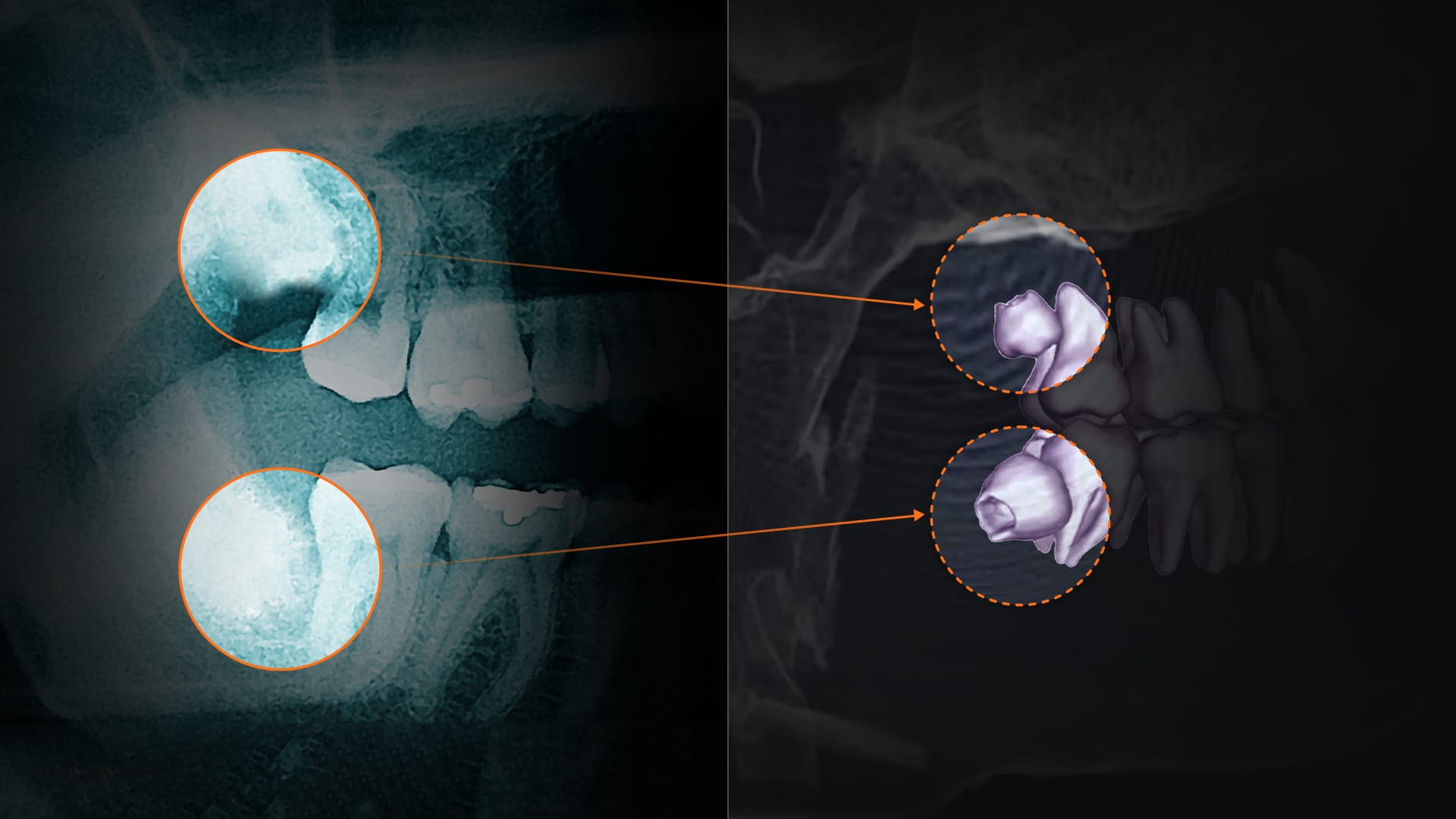 2차원 X-ray와 3차원 CBCT 영상을 비교하여, 3차원 CT가 매복치 등 숨은 치아 이상을 더 명확히 진단함을 강조하는 이미지
