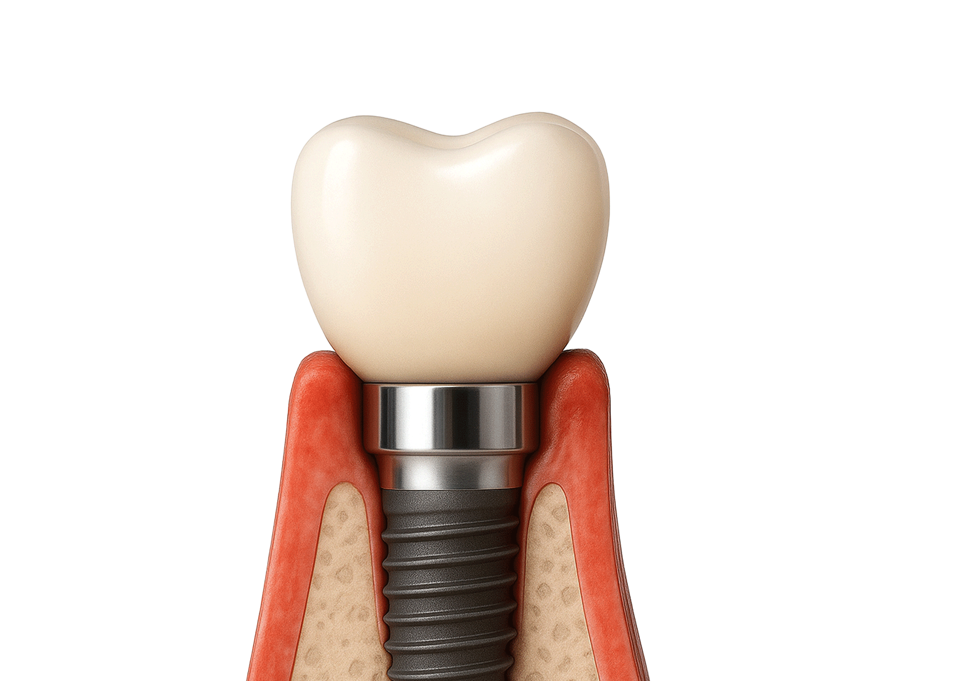 An image showing bone absorption due to bone graft failure, or bone dissolving due to inflammation at the graft site