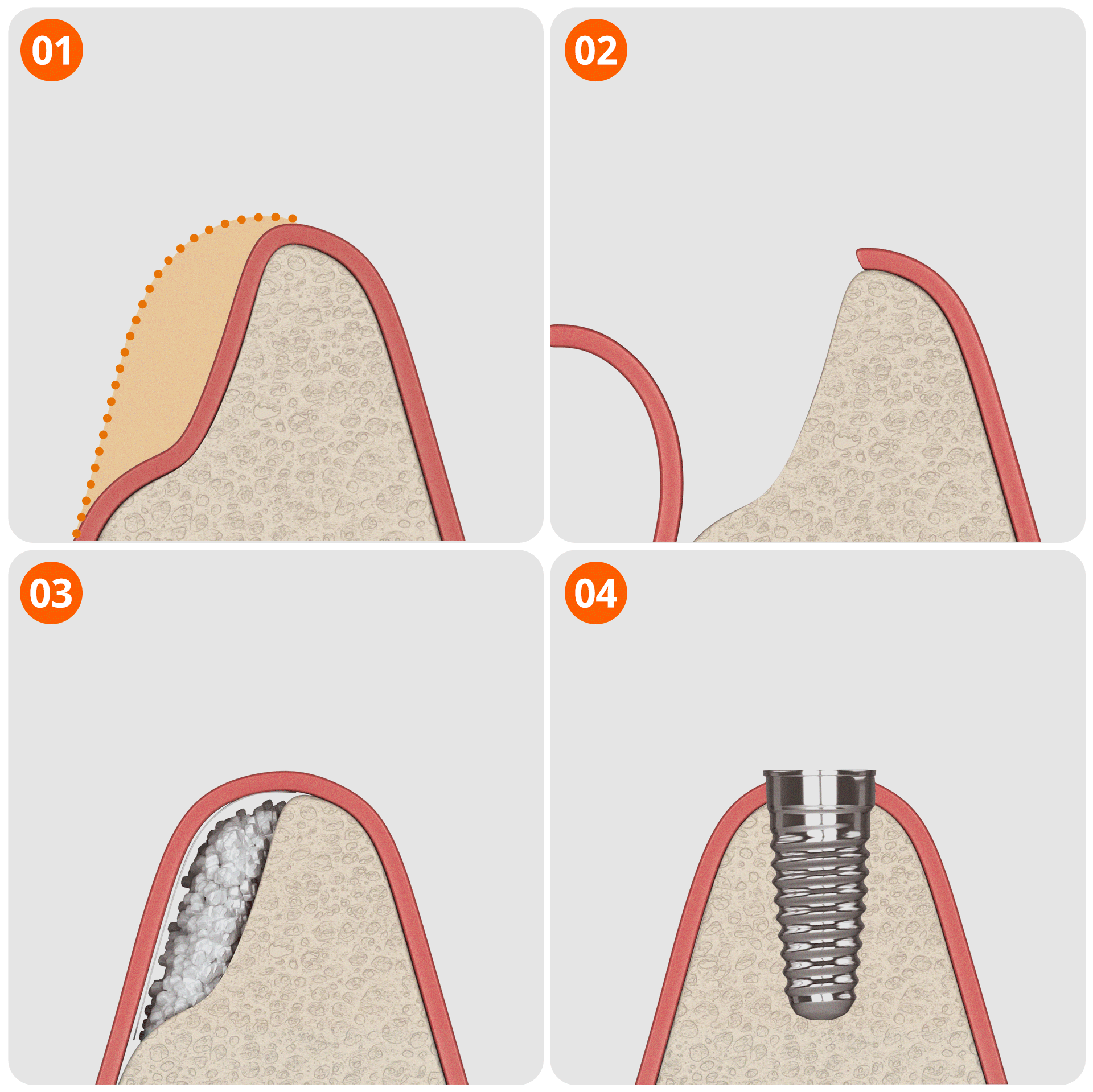 An infographic showing the procedure steps for dental implant bone grafting