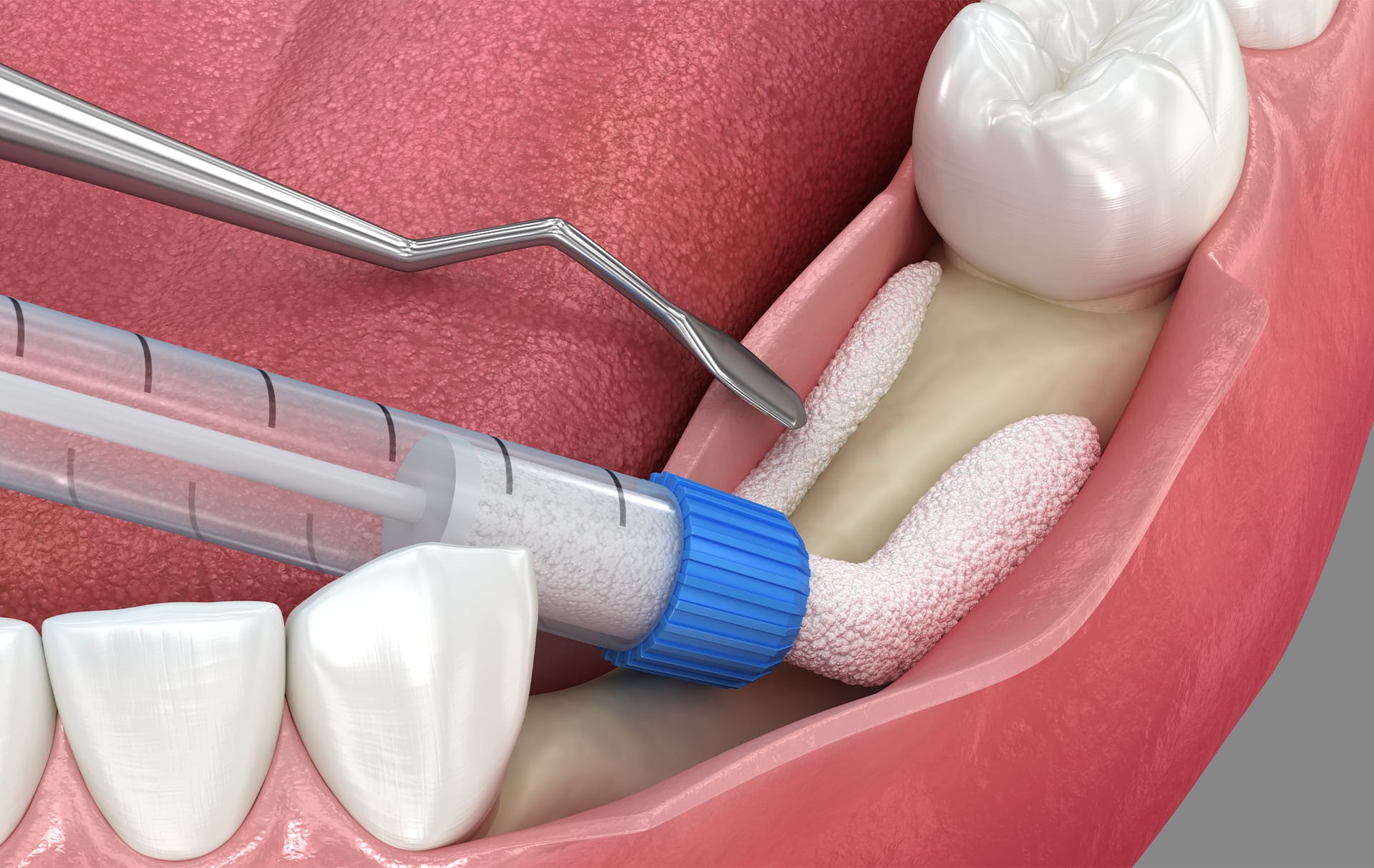 骨補填材を挿入している場面