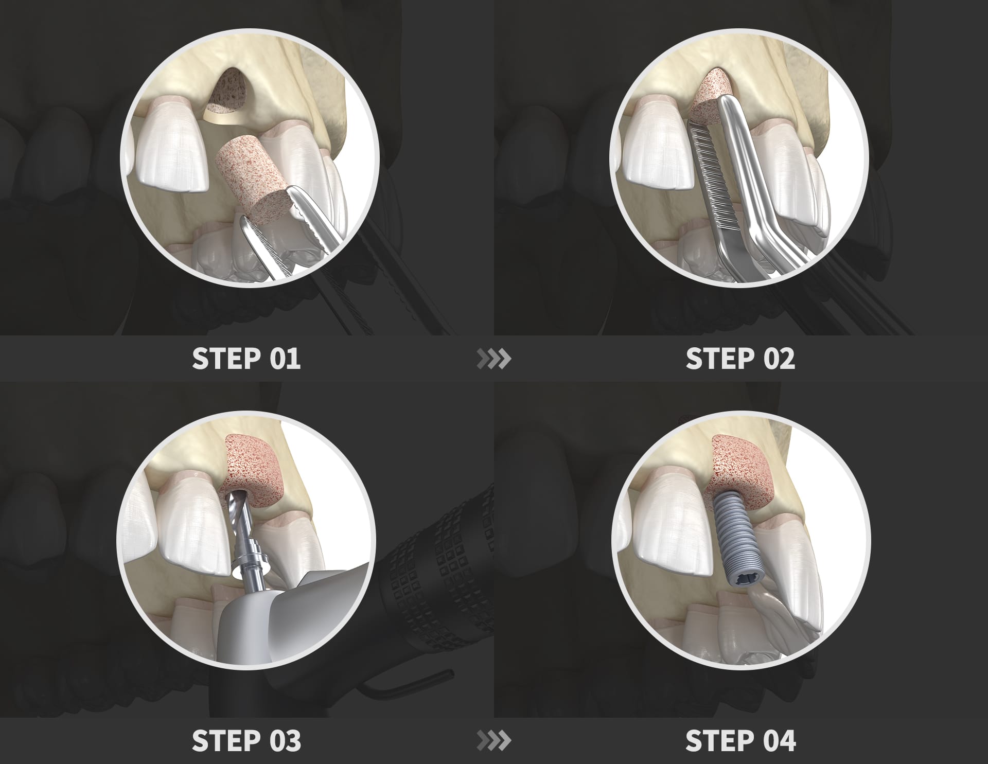 骨造成インプラントの全体プロセス