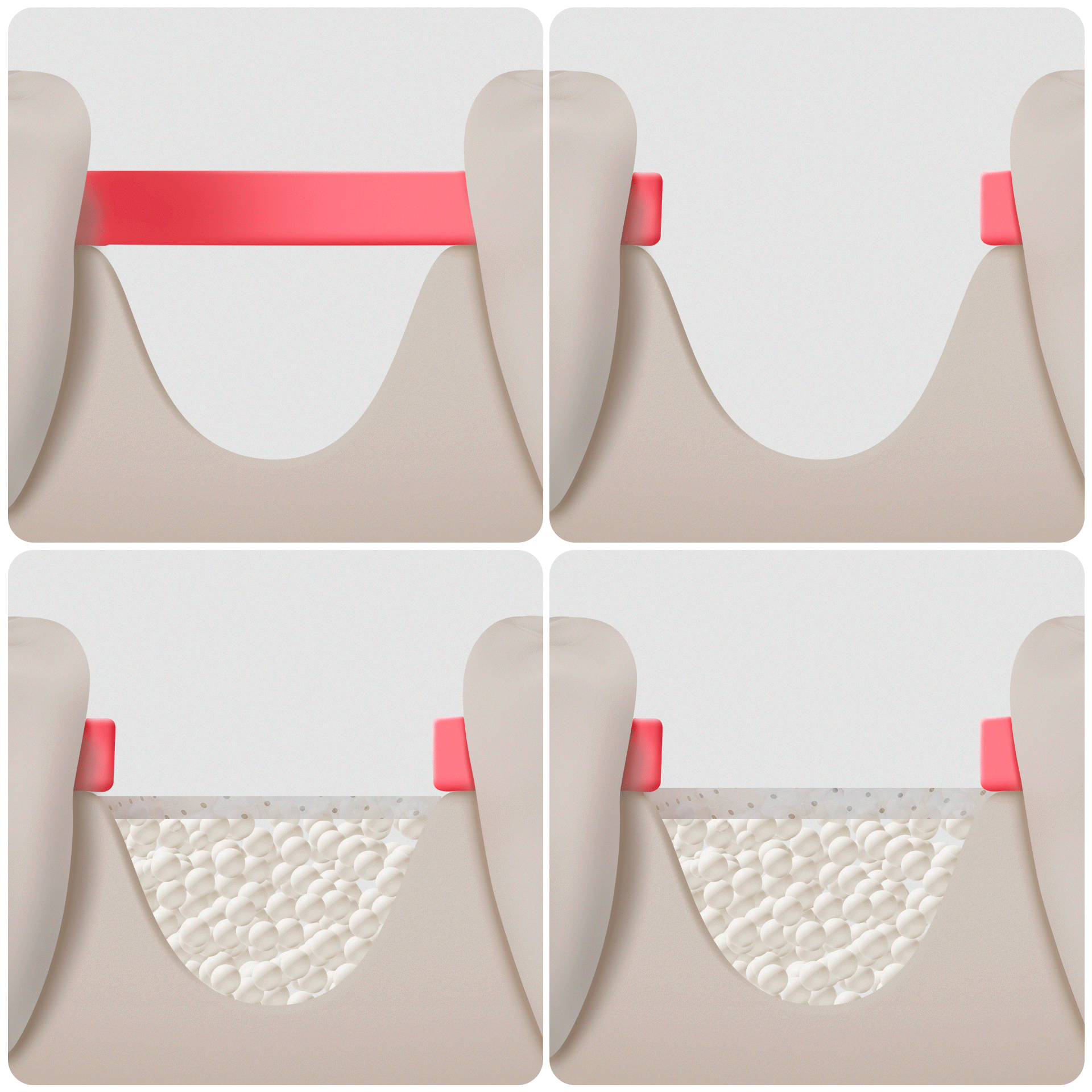 Recovery stages of dental implant bone grafting (3–6 months): A flowchart from graft insertion to complete osseointegration