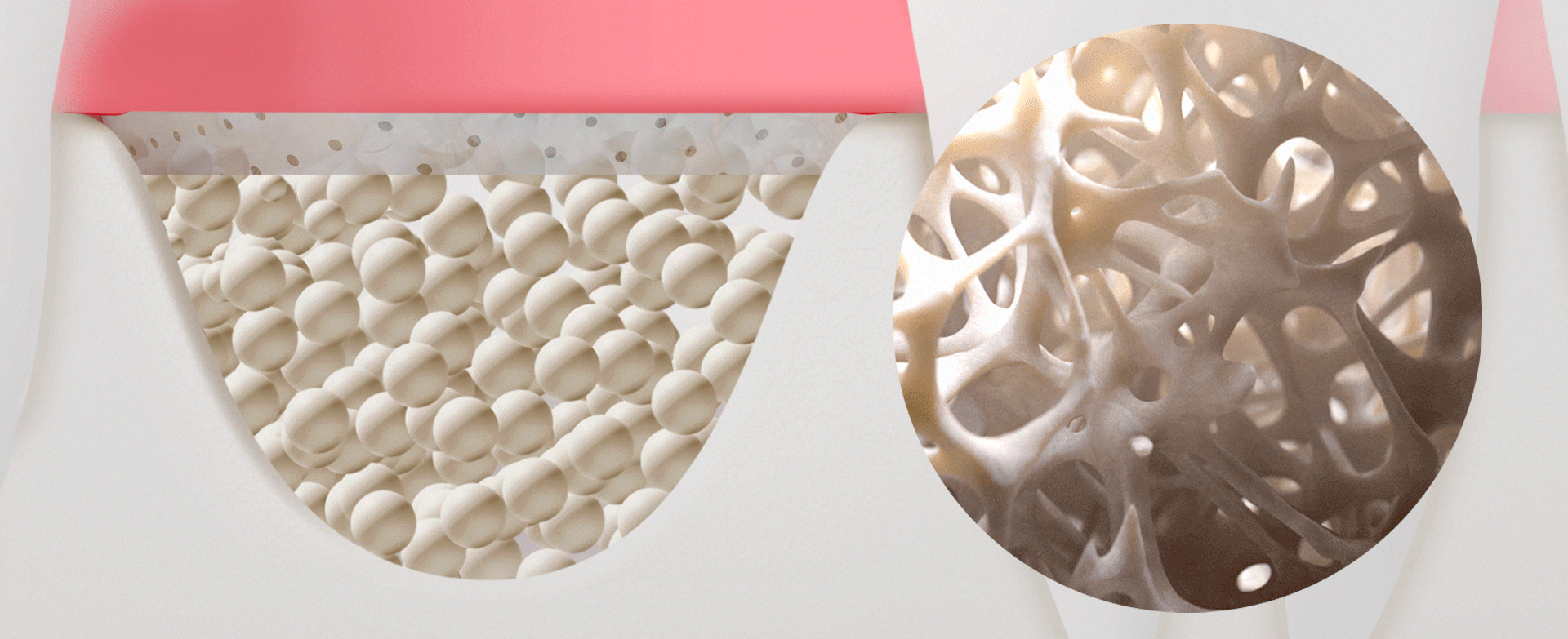 The physiological process of bone formation following a dental implant bone graft