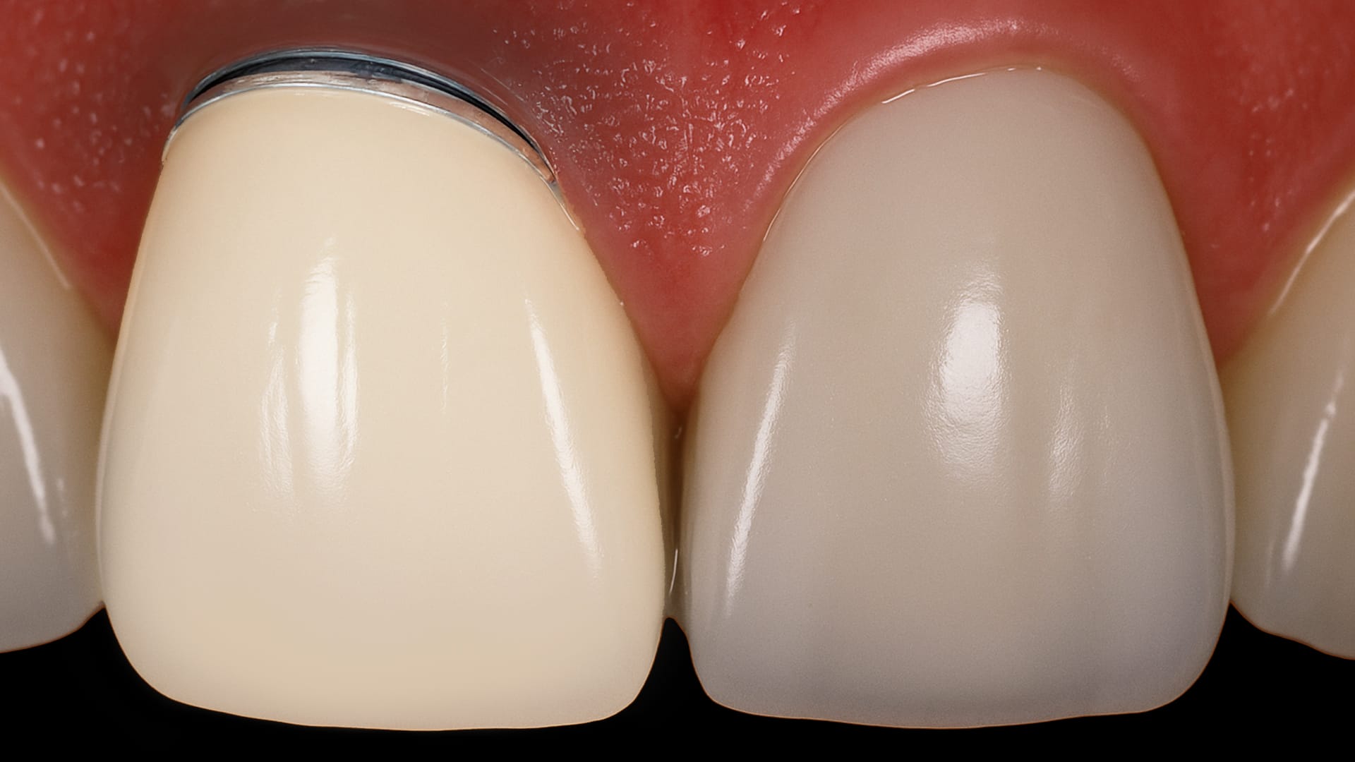 PFM 크라운으로 임플란트 식립되어 있는 모습 