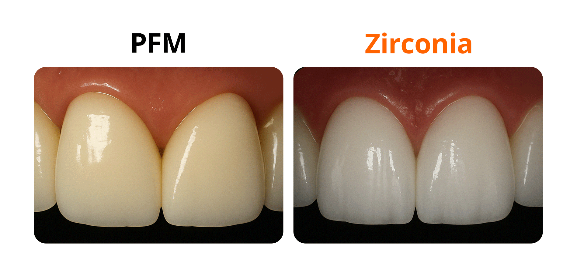 PFM과 지르코니아 크라운의 식립 모습을 비교한 이미지 