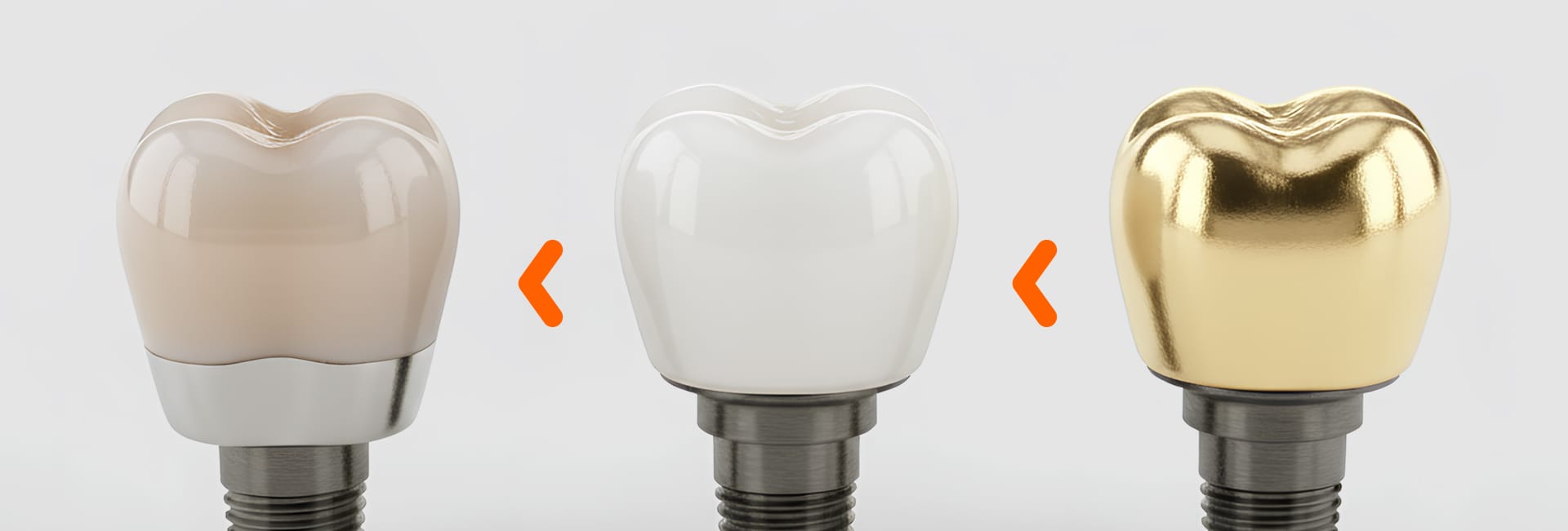 임플란트 크라운의 가격차이를 나타낸 이미지
