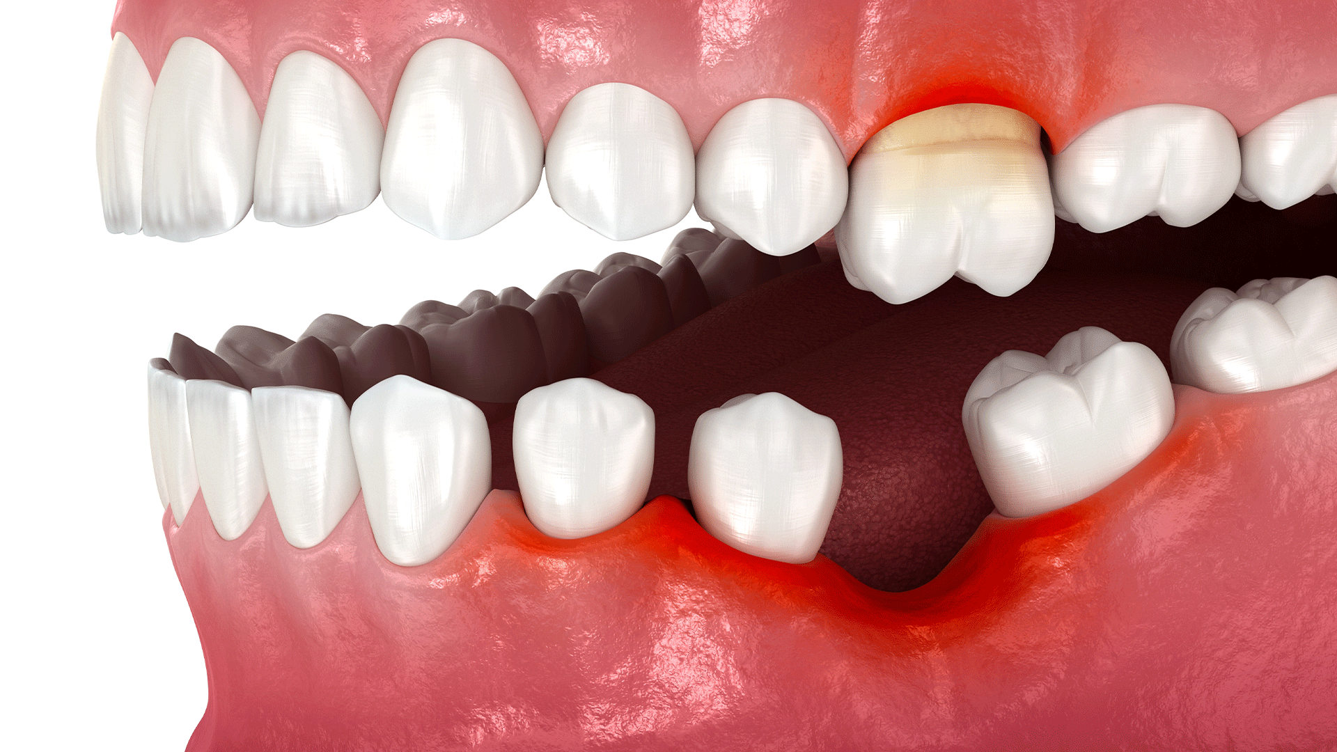 치아가 빠진 곳의 치조골이 절반 정도 흡수되어 있는 모습