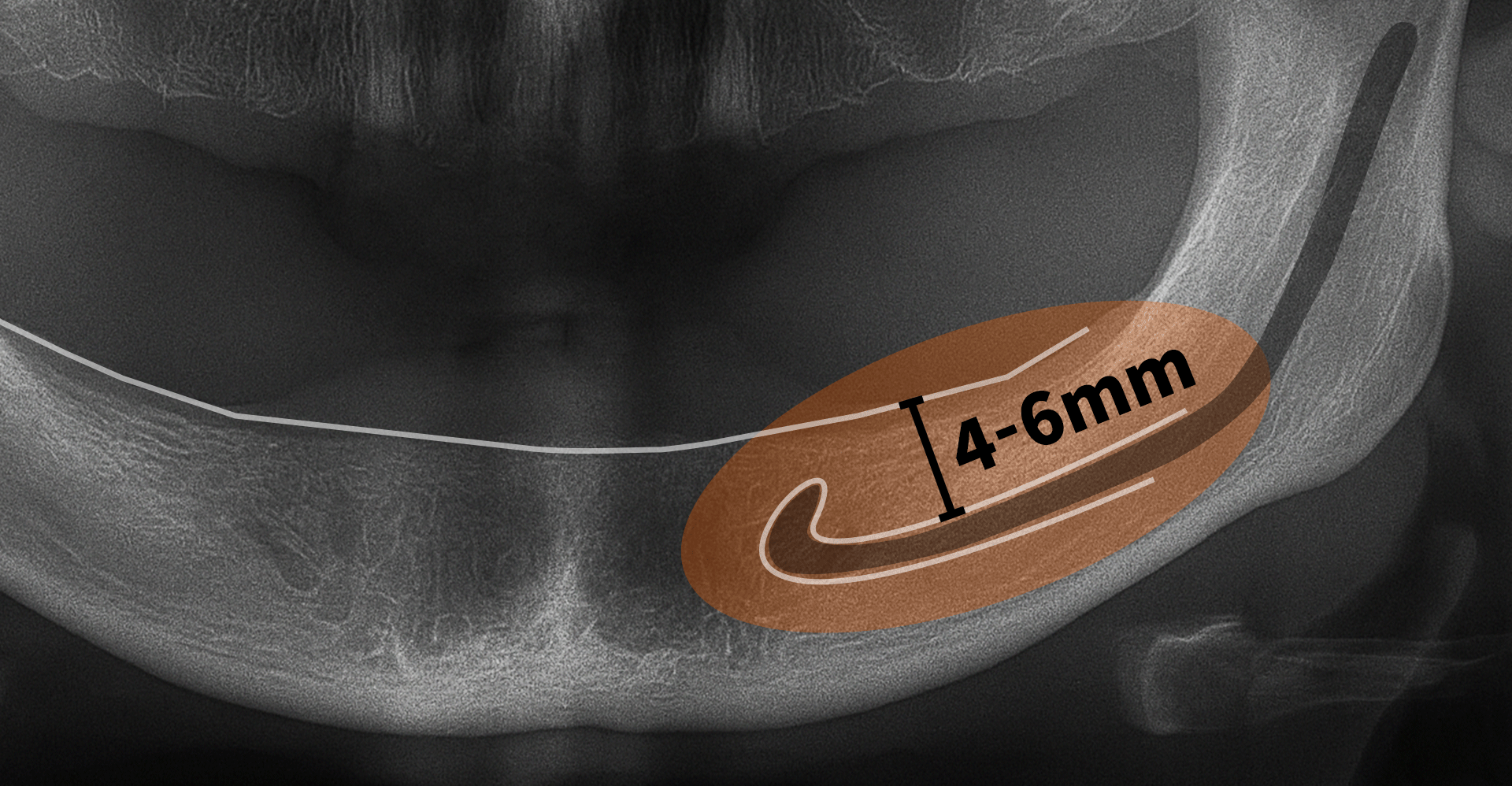 전악임플란트를 위한 잇몸뼈 기준을 구강 내 표시한 이미지