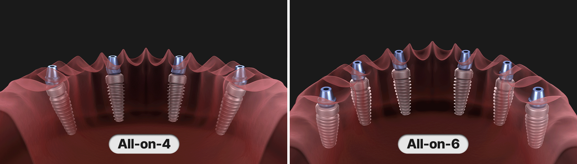 All-on-6, All-on-4 치아 식립을 보여주는 이미지