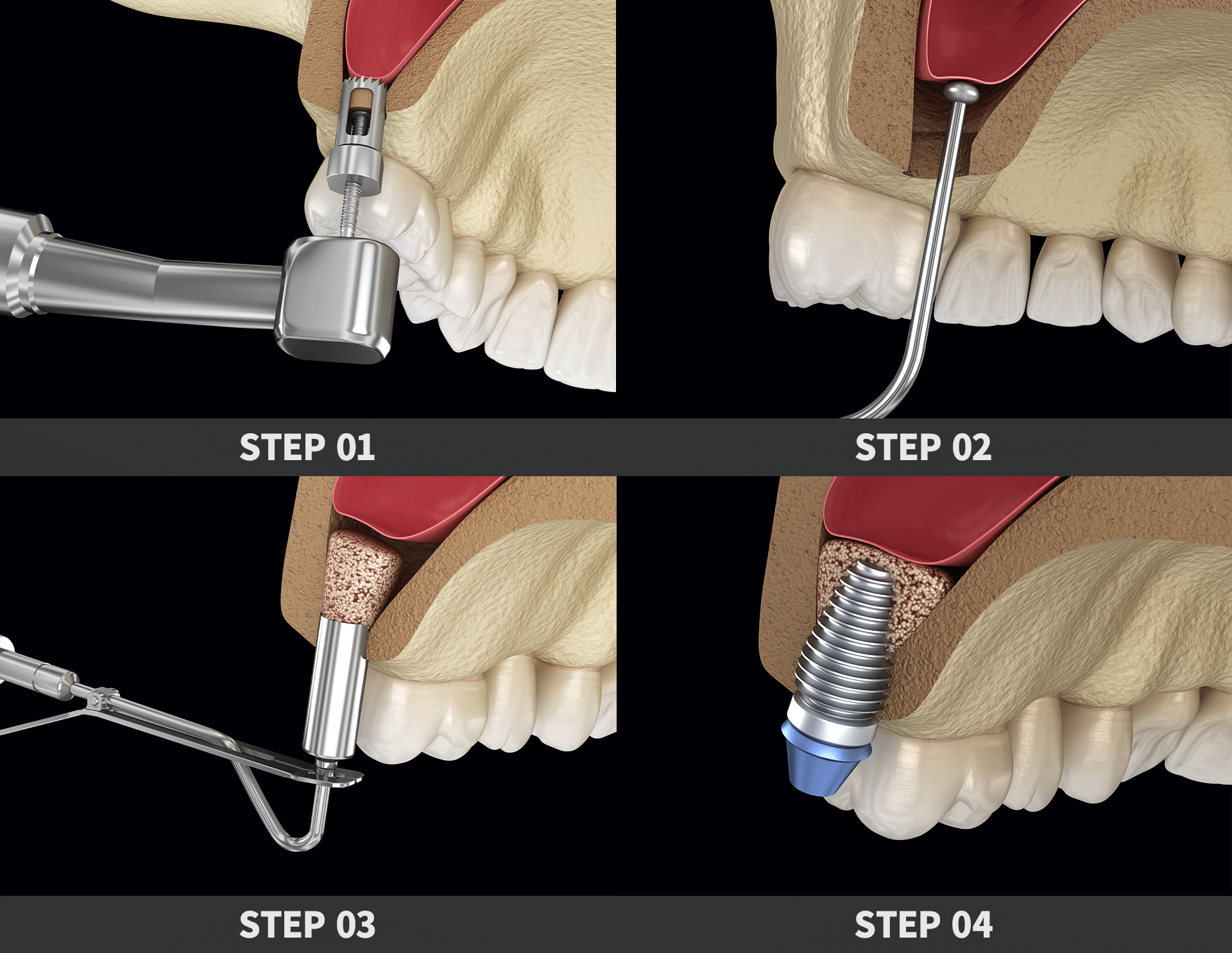 잇몸뼈 보강 수술인 상악동 거상술의 진행 절차
