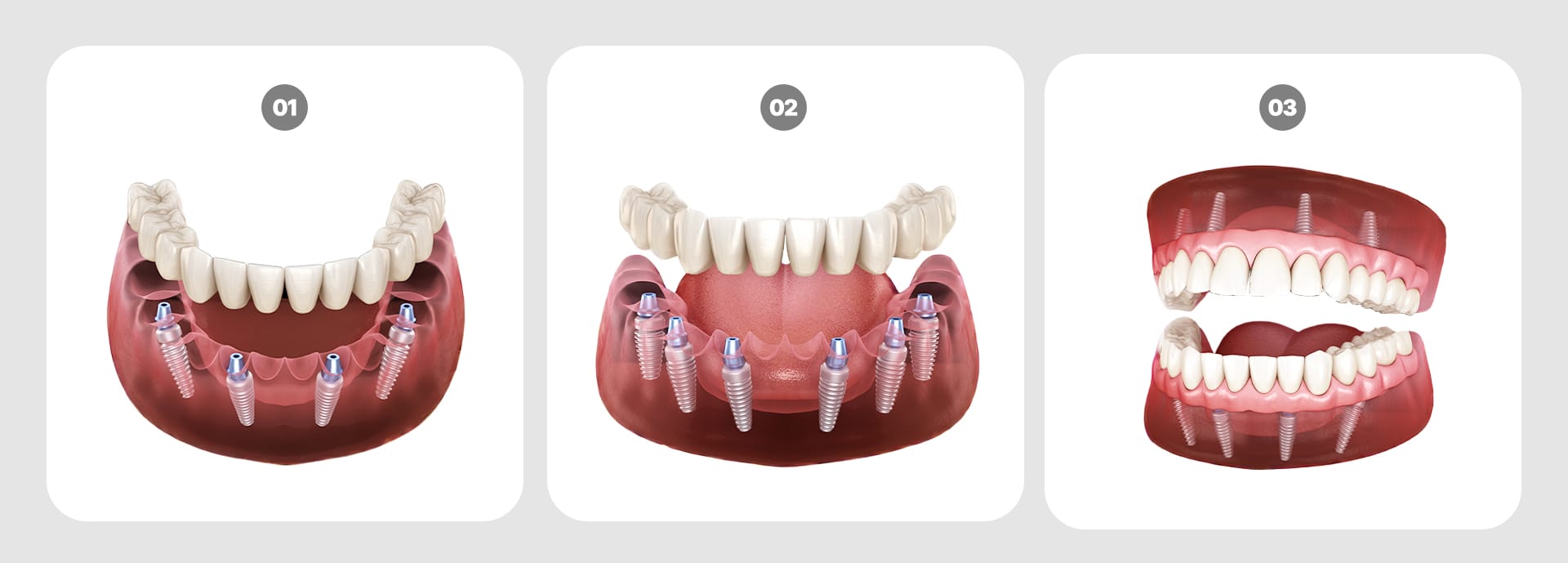 Types of full-mouth implants: All-on-4, All-on-6, and full-mouth implants (Full-mouth restoration)