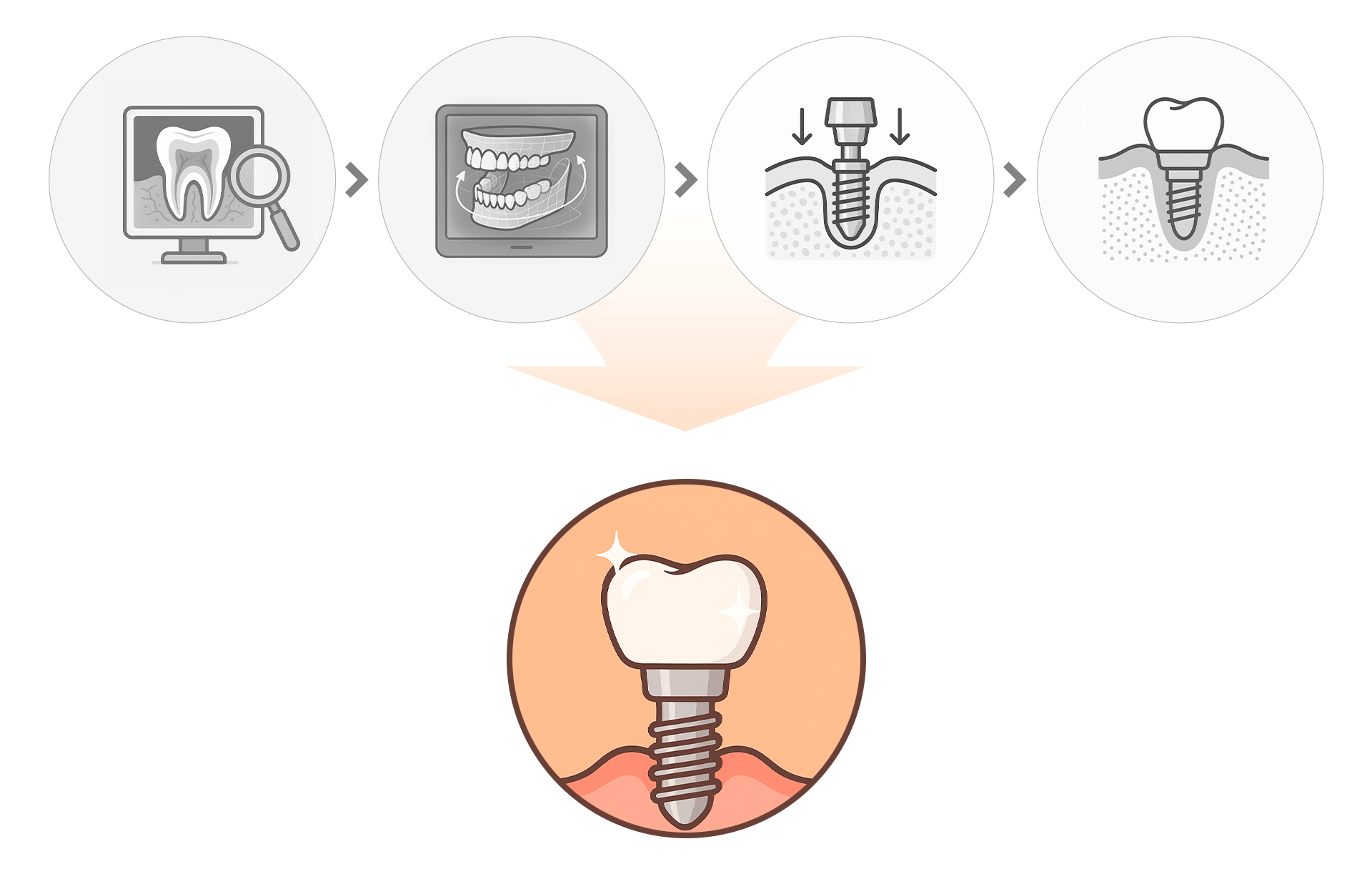 An infographic showing the procedure steps for full-mouth implant surgery