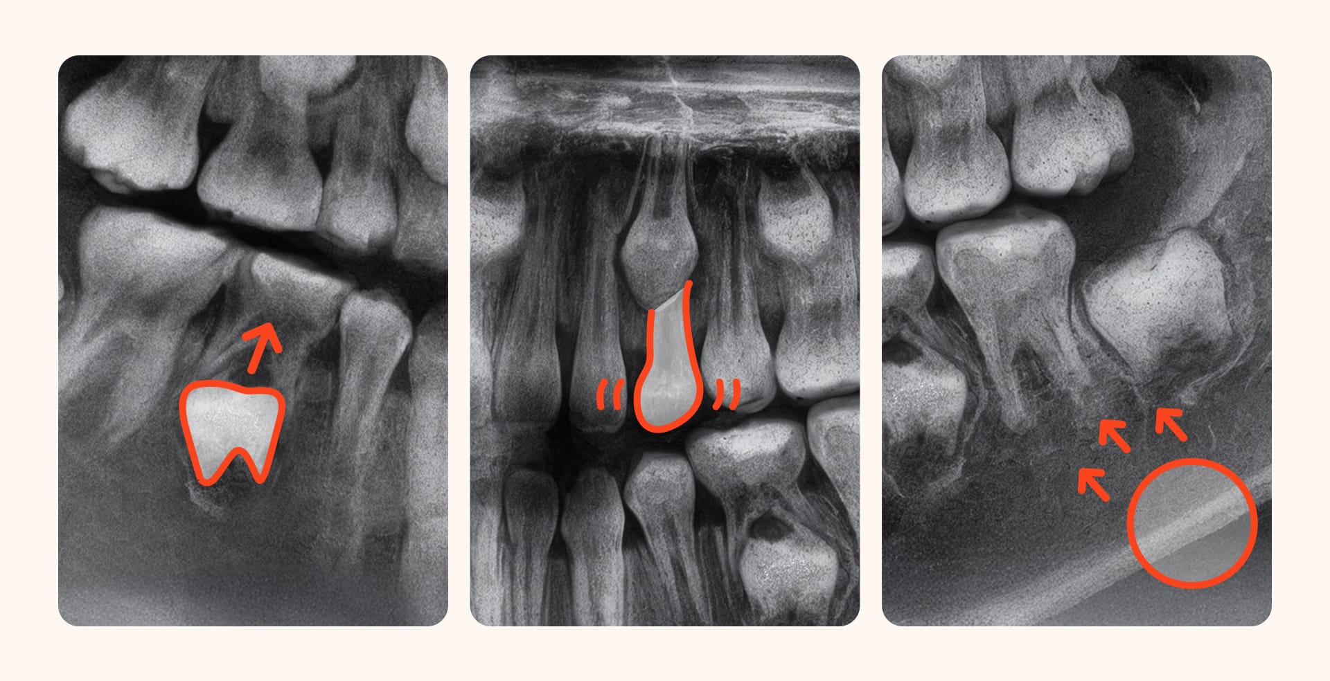 성장기 교정의 부정교합의 사례를 나타낸 엑스레이 자료