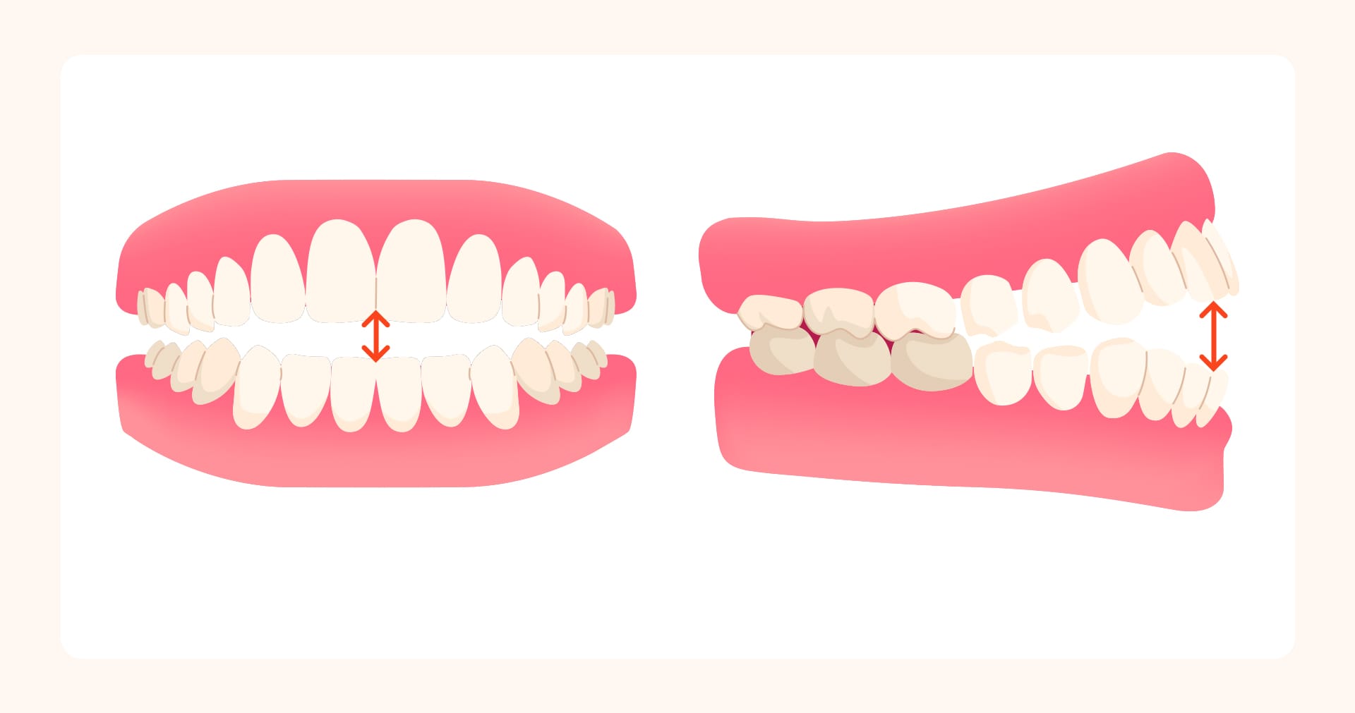 치아 모형을 통해 부정교합을 설명한 의학적 일러스트